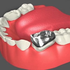 Dental Crowns